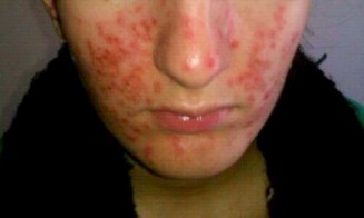 Severe Anaphylaxis to NSAIDS