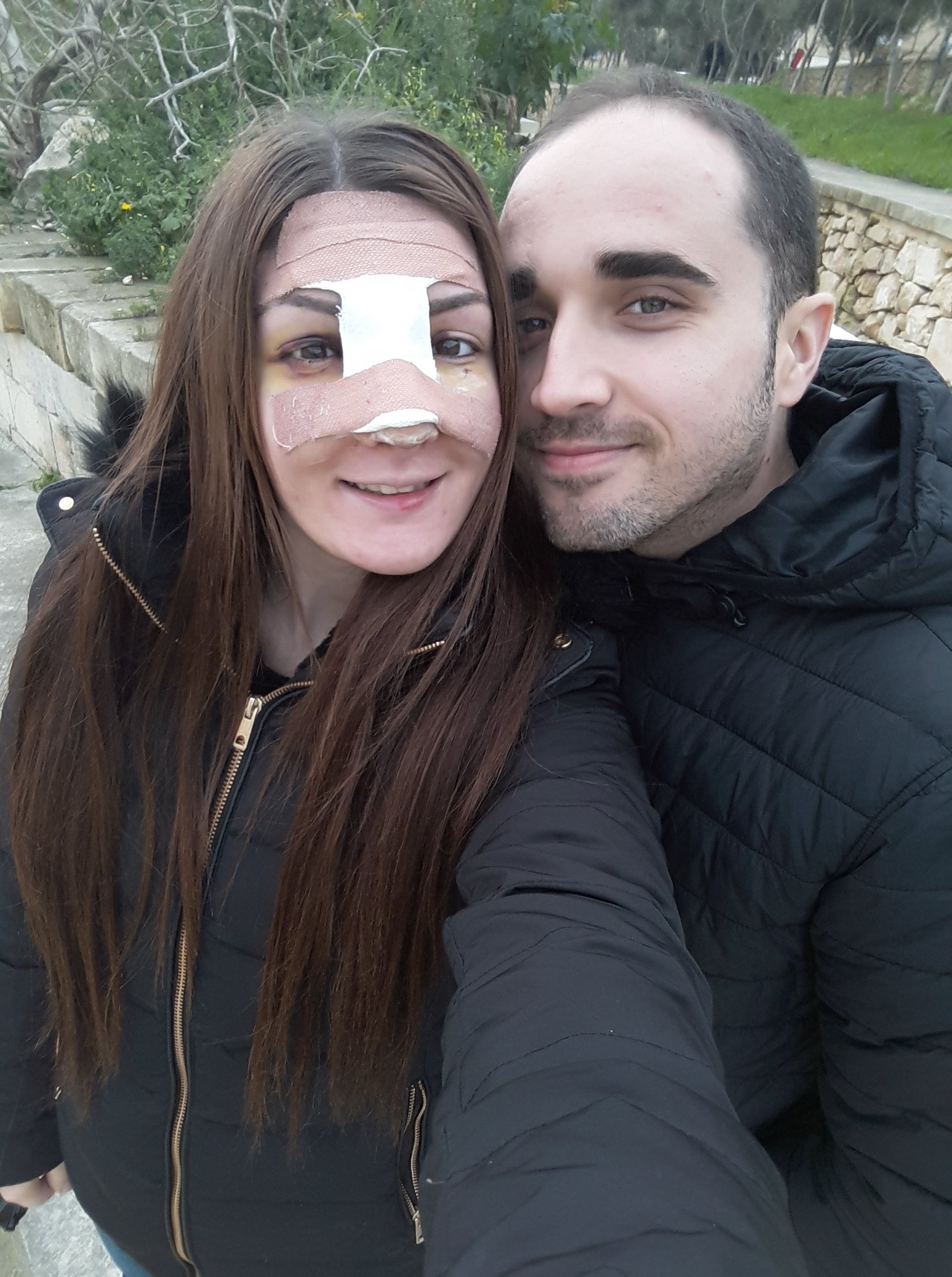 My Rhinoplasty Experience: First Week Recovery, Day 3