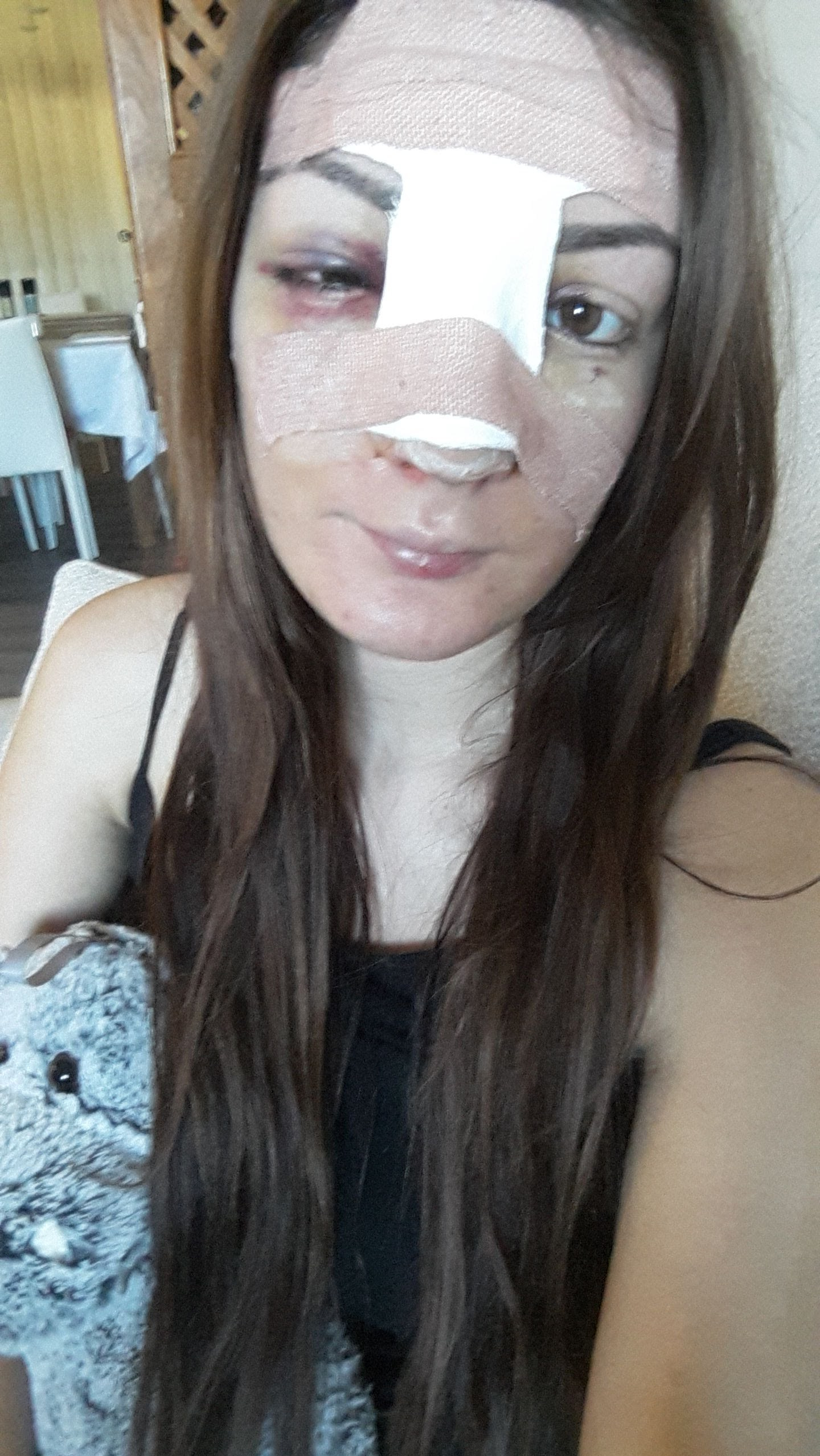 My Rhinoplasty Experience: First Week Recovery, Day 2