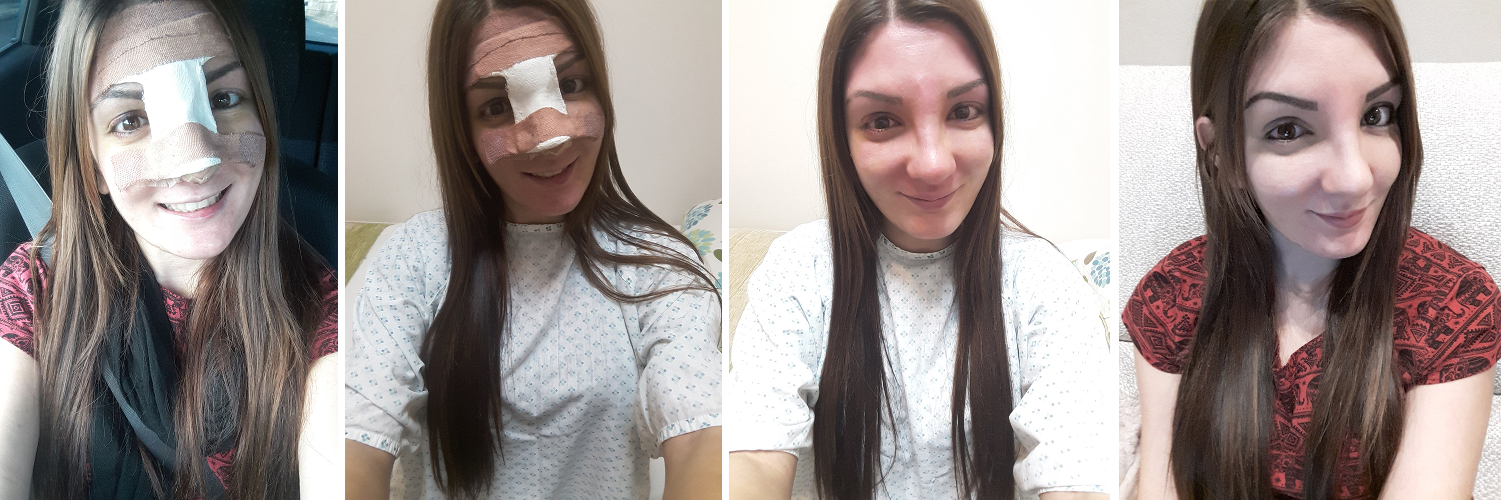 My Rhinoplasty Experience: The Big Reveal