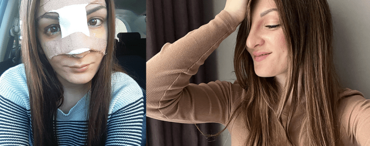 Rhinoplasty Malta Recovery Before and After